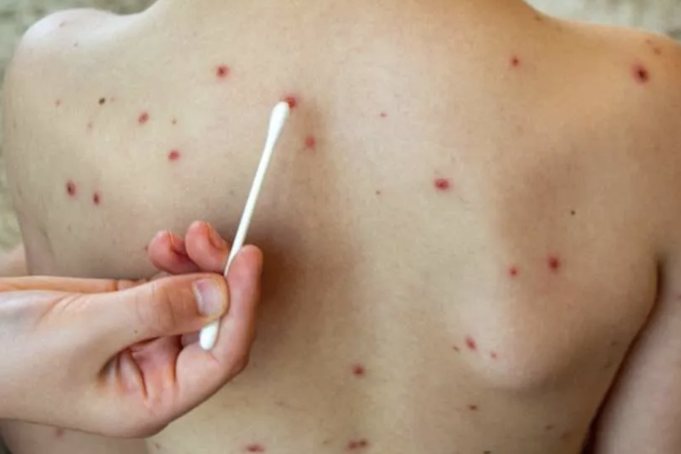 ALERTA SANITARIA EN MÈXICO POR BROTES IMPORTANTES DE SARAMPIÒN EN VARIOS PAÍSES’